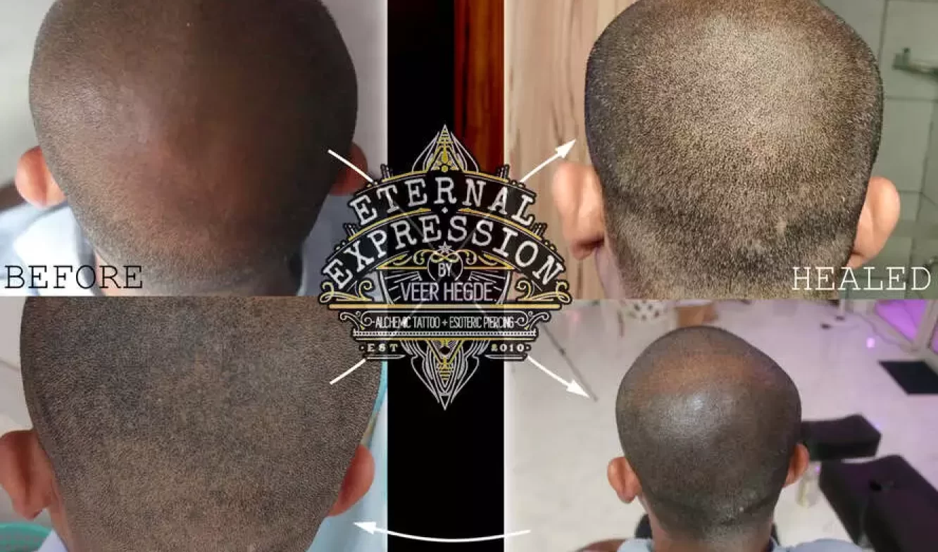 Scalp Hair Follicle Tattooing / Scalp Micro-Pigmentation In Bangalore » One Of India's Best Tattoo Studios In Bangalore - Eternal Expression
