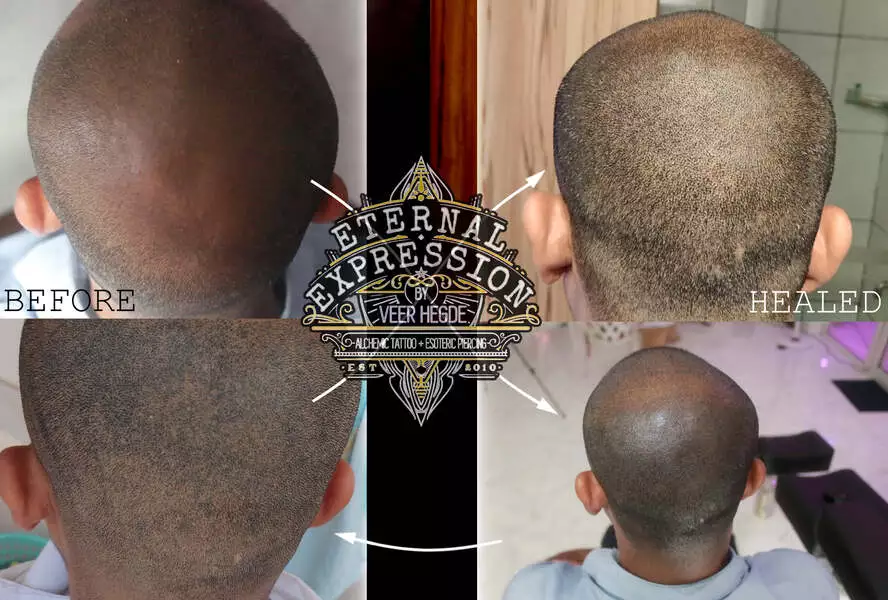 Scalp Hair Follicle Tattooing / Scalp Micro-Pigmentation In Bangalore » One  Of India's Best Tattoo Studios In Bangalore - Eternal Expression | Since  2010